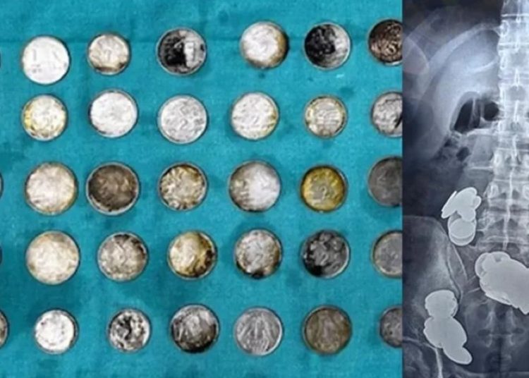 Κατάπιε κέρματα και μαγνήτες για να «χτίσει» σώμα